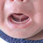 Tongue-tie,Patient,,,Baby,Health,Problem,,,Baby,Show,Tongue